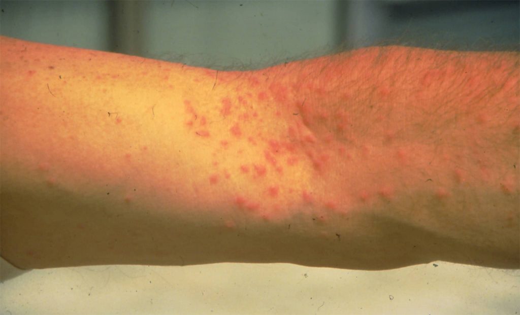 Skin irritation due to toxic hairs of the oak processionary caterpillar