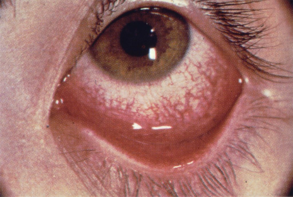 Eye irritation due to exposure to toxic hairs of the oak processionary caterpillar